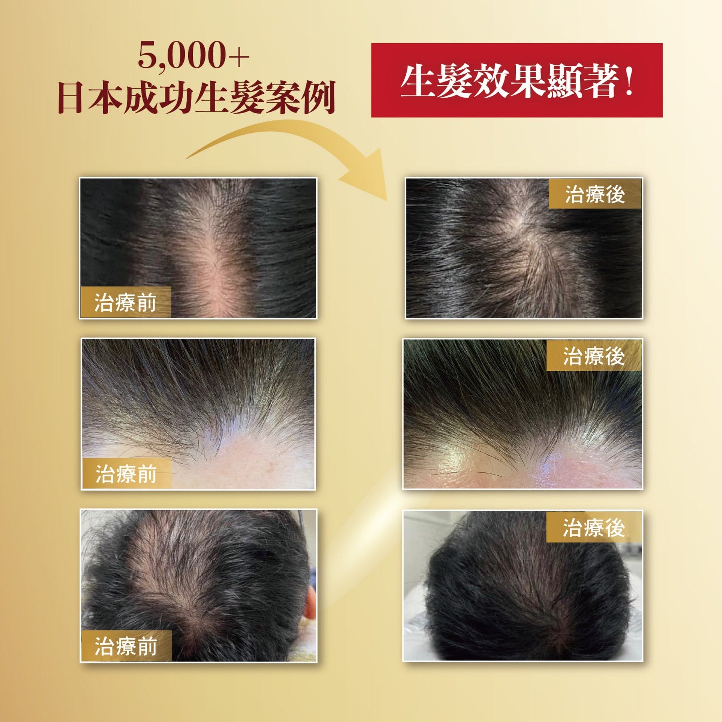 【Popular Choice】airdermar x HAIRACLE⁺ Discover the Miracle Hair Growth Treatment